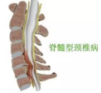 脊髓型颈椎病诊断要点